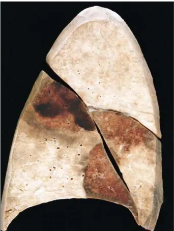 Fig. 4 - Hemorrhagic infarcts in the middle and lower lobes of the right lung.