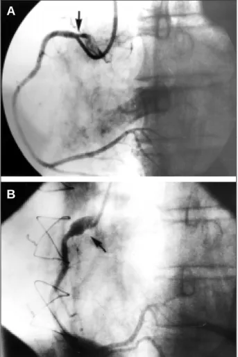 Fig. 2 – Left coronary – preoperative cinecoronariography: significant stenosis of the coronary ostium is observed; postoperative cinecoronariography demonstrates adequate ostial amplification.