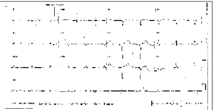 Fig. 1 – Low voltage complexes in the frontal plane, reduction of the septal forces, and diffuse changes of ventricular repolarization.