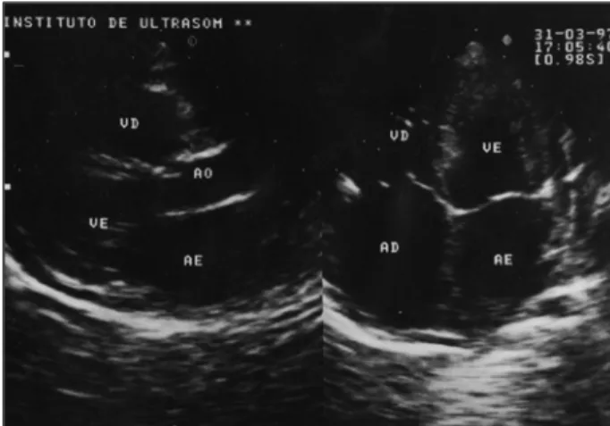 Fig. 1- Echocardiography. Pericardial thickening ( arrows).