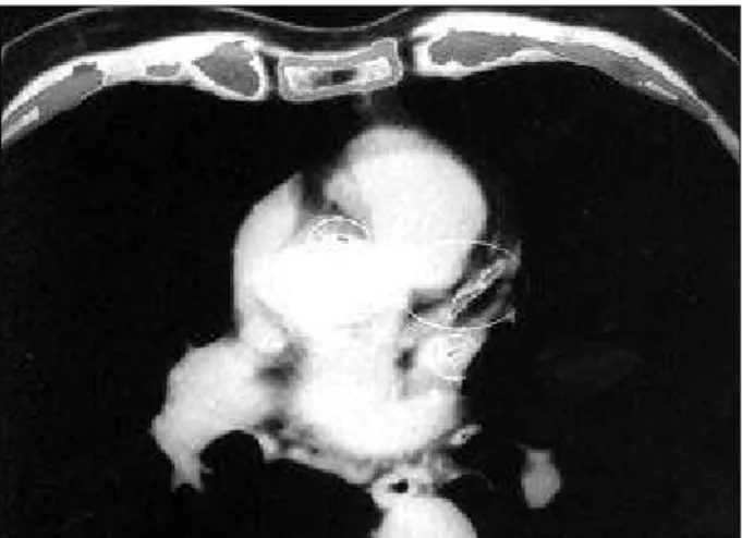 Fig. 1 – Tomographic section showing calcifications in the wall of the ascending aorta and left coronary artery
