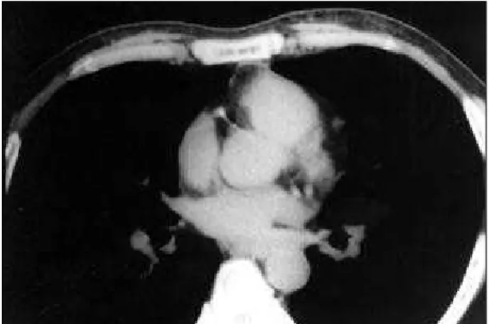 Fig. 2 – Demonstration of calcification in the anterior descending artery in a tomographic section