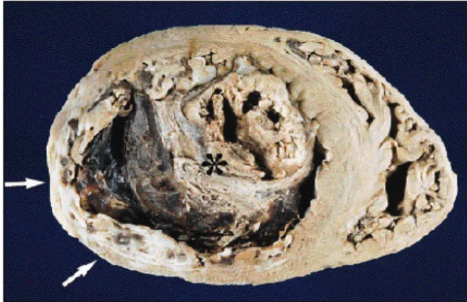 Fig. 3 – Transection of the ventricles. Note the scar of transmural infarct with thinning of the left ventricular posterolateral wall (arrow) and extensive thrombosis (asterisk) of the left ventricular cavity.