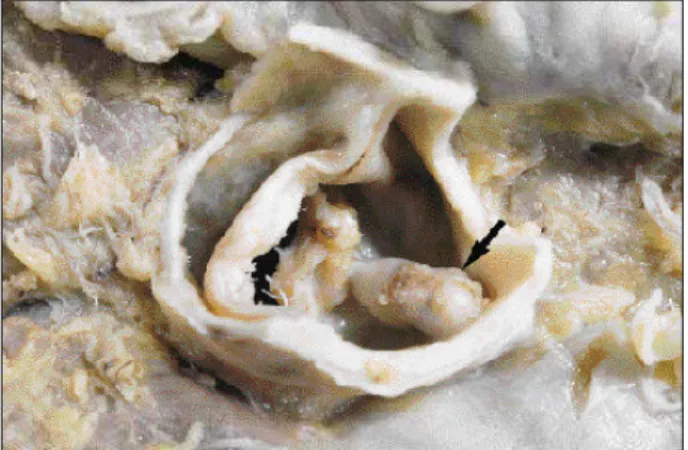 Fig. 4 – Aortic valve seen from its arterial face, composed of two thickened leaflets with a dense calcification at the raphe (arrow).
