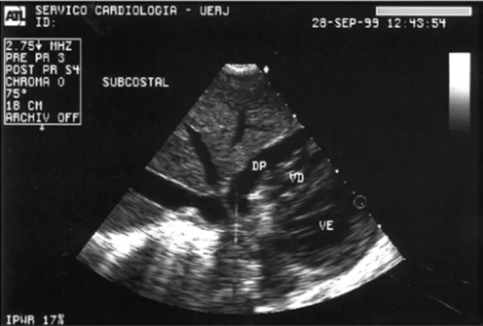 Fig. 1 – Echocardiogram performed immediately after pericardicentesis with immediate relief of symptoms showing residual pericardial effusion
