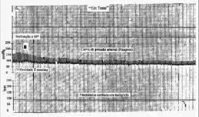 Fig. 2 – Valsalva maneuver – The different phases of the maneuver are not shown.