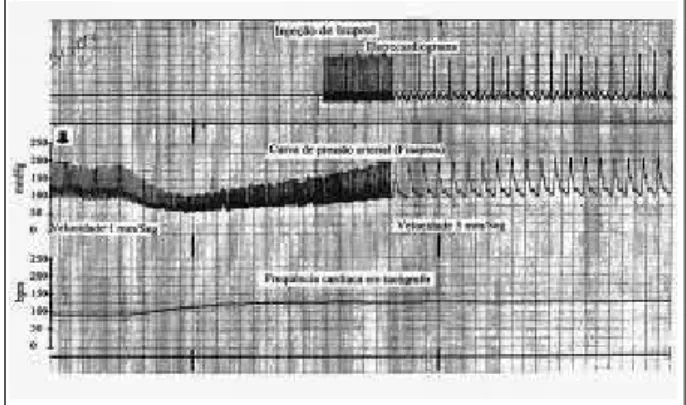 Fig. 4 – Bradycardia reflex - Blood pressure curve beat-to-beat (Finapres) and heart rate on electrocardiogram and tachograph during bolus injection of  pheny-lephrine