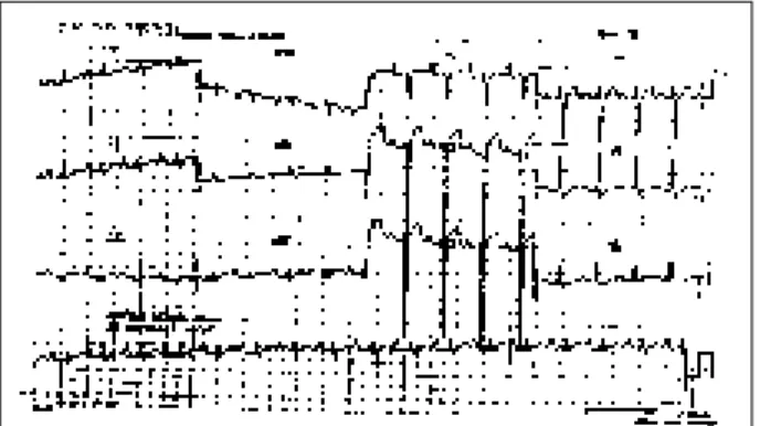 Fig. 2 – Electrocardiogram. Biatrial and left ventricular overload.