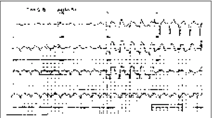 Fig. 3 – Electrocardiogram. Atrial rhythm with widened QRS and elevation of the ST segment.