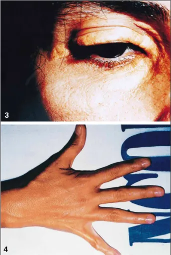 Fig. 2 – Tendinous xanthomas in the fingers in case 1, prior to ileal bypass surgery.