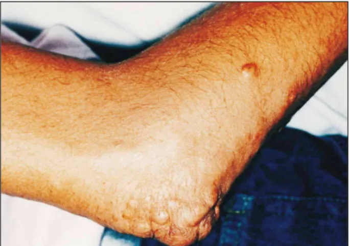 Fig. 5 – Tendinous xanthomas and xanthoma tuberosum in the elbow in case 2, prior to ileal bypass surgery.