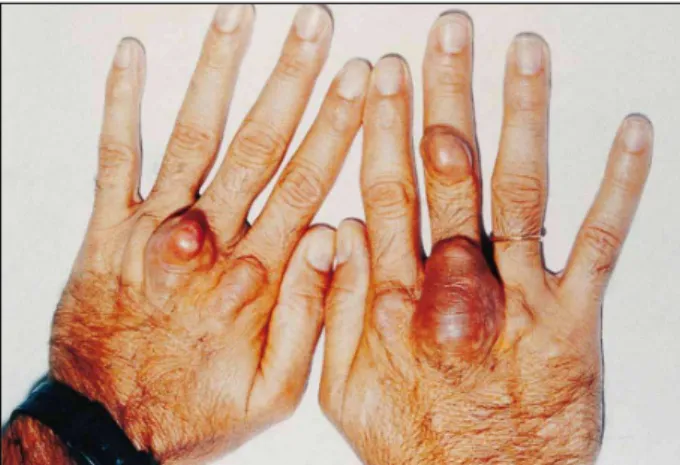 Fig. 8 – Same patient of fig. 7 evolution of the xanthomas after a 6-year follow-up with irregular use of lipid-lowering drugs ( Same patient of fig
