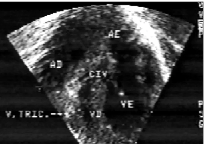Fig. 3 - Cut demonstrating through color-Doppler, flow from left ventricle to right ventricle.