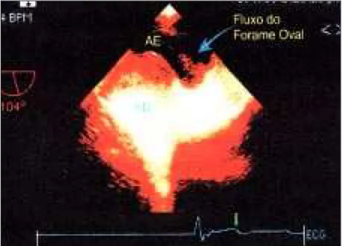 Fig. 2 - Transeophageal echocardiography showing flow through patent foramen ovale.