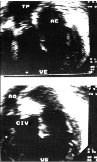 Fig. 1 - Upper  panel: Four chamber view depicting. Tricuspid atresia (arrow) and the hypoplastic right ventricle (VD).