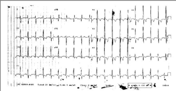 Fig. 2 - Electrocardiogram – Sinus tachycardia and right ventricular hypertrophy more marked than in the initial electrocardiogram.