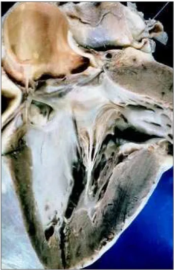 Fig. 3 – Section of the left ventricular outflow tract showing the defect of the perimembranous ventricular septum, which is totally occluded due to the adhesion and fibrosis of the anterior and septal leaflets of the tricuspid valve to the margins of the 