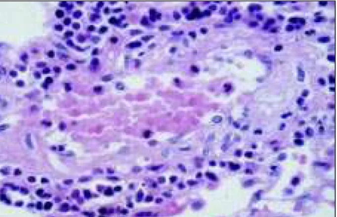 Fig. 5 - Histologic section of the lung showing moderate lymphomononuclear in- in-flammatory infiltrate around a pulmonary arteriole