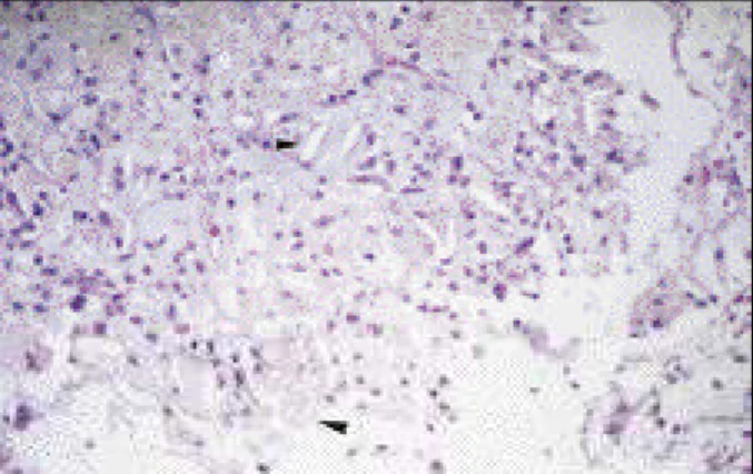 Fig. 1 - Cholesterol pericarditis: xanthomatous macrophages containing fat and crystals of cholesterol (HE, 10x).