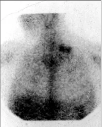 Fig. 2 - Ultrasonography of the left supraventricular region revealing the presence of confluent adenomegaly.