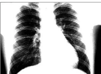 Fig. 1 - Área cardíaca aumentada e pedículo vascular alargado.