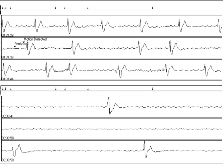 Fig. 3 – Case 2 - Initial rhythm: flutter or atrial tachycardia with AV block high degree and right brunch block pattern
