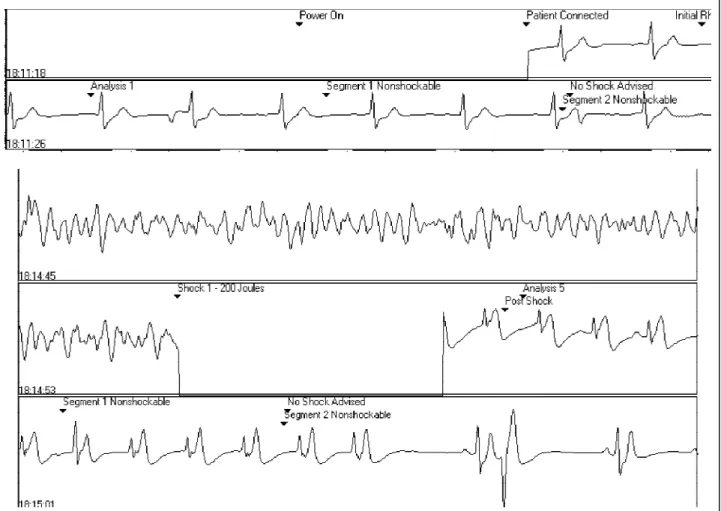 Fig. 4 – Case 3 - Initial strip connect to the electorde; intermediate strips VF with chock; inferior strips 2 minutes after VF successfully revert, wth sinus rhythm and STT normal.