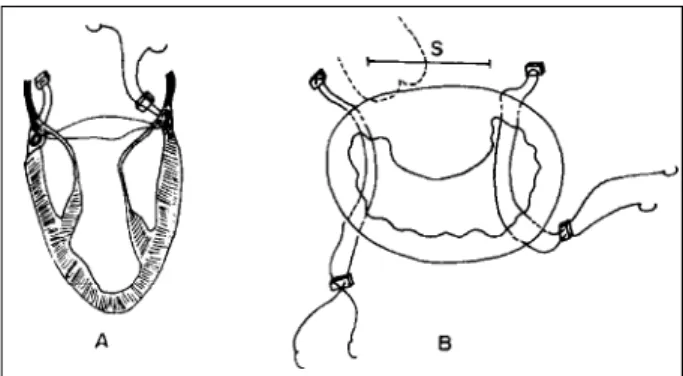 Fig. 5 - Representation of the Wooler’s type placement of annuloplasty points. A) Stitches of braided polyester string anchored in Teflon felt are crossed through the mitral leaves insertion ring; B) stitches aiming at reducing the mural leaf, without comp