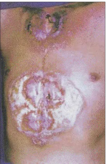 Fig. 2 - The soft tissue necrosis was still in progress after the initial debride- debride-ment.