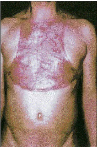 Fig. 5 - At hospital discharge, the recipient area was completely covered by skin flaps from the thighs.