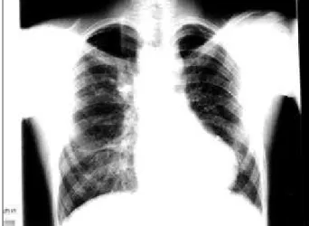 Fig 1 - Radiografia de torax salienta aspectos encontrados na tétrade de Fallot, mas com assimetria da vascularidade pulmonar maior à direita