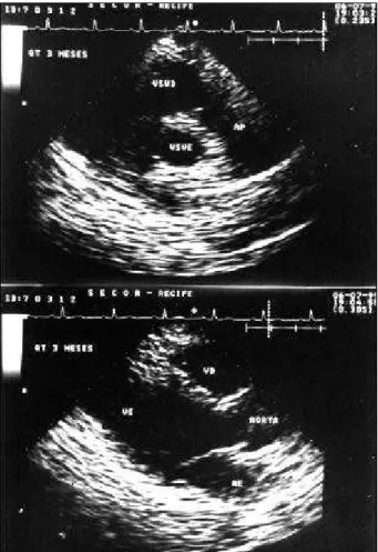Fig. 2 – Polygonal cells in an alveolar pattern with pleomorphic nuclei and fibrous