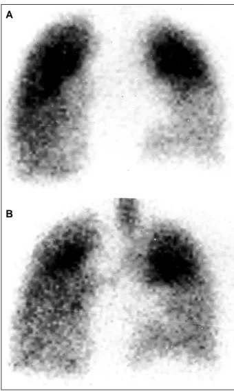 Fig. 3 - Pulmonary perfusion scintigraphy (fig. 3A) showing hypoperfusion in the right lung lower lobe similar to the pattern found in ventilation slan (fig