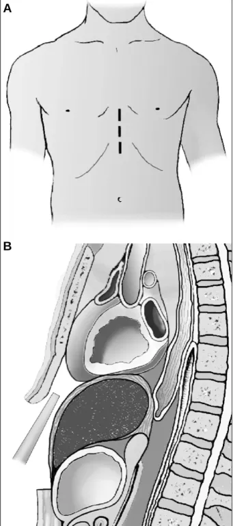 Fig. 1 - A) Incision of approximately 3-4 cm of length on the xiphoid process and linea alba; B) sketch of the entrance of the video equipment and visibility of the pericardium.