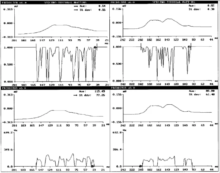 Figure 1 shows the P-wave signal-averaged electrocar- electrocar-diogram frequency-domain analysis of patients in groups I (negative examination) and III (positive examination).
