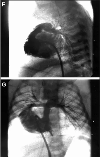 Fig. 2 - Case 2 -F and G) right ventriculography in posteroanterior and left profile views after the procedure: Note establishment of the right ventricle-pulmonary artery continuity with minimum sub-pulmonary reaction and reduction in tricuspid insufficien