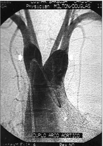 Fig. 3 – Axial section of nuclear magnetic resonance showing wide aortopulmonary window (arrow)
