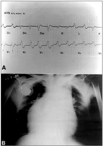 Fig. 2 – A) Echocardiogram showing the right atrium (RA) connected to the morpho- morpho-logically left ventricle (LV), from where the pulmonary artery (PA) emerges, and the presence of subpulmonary stenosis (arrow)