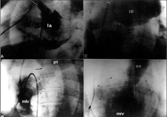 Fig. 3 – A) Angiography in the right superior pulmonary vein showing the normal drainage to the left atrium (LA) and passage of the contrast medium to the right atrium, through a wide atrial septal defect (white arrows); B) angiography in the  mor-phologic