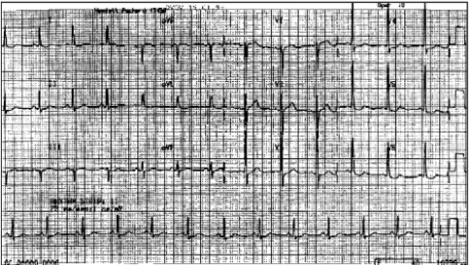 Fig. 1 - Electrocardiogram: left ventricular hypertrophy.