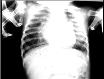 Fig. 1 - Radiografia de tórax mostra aumento da área cardíaca e da trama vascular pul- pul-monar e abaulamento inusitado do arco médio esquerdo.