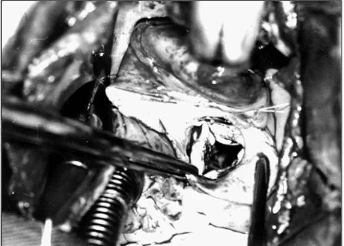 Fig. 4 – Note the complete commissurotomy