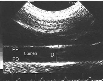 Fig. 1 – Two-dimensional image of common carotid artery longitudinal cut. PW- PW-proximal wall; DW - distal wall; A- adventitious layer; M - middle layer; I- inner layer; D -  arterial diameter.