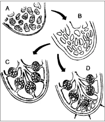 Fig. 2 – Computed tomography depicting images of excessive attenuation in the right lung close to the posterior wall with confluence of the vessels determining the possibility of pulmonary arteriovenous fistula.