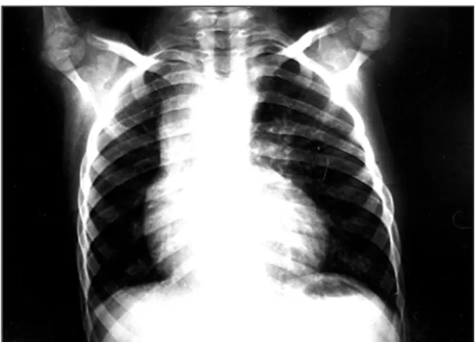 Fig. 1 - Radiografia de tórax mostra a mesoposição cardíaca, a hipoplasia pulmonar direita e a trama vascular pulmonar diminuída à direita.