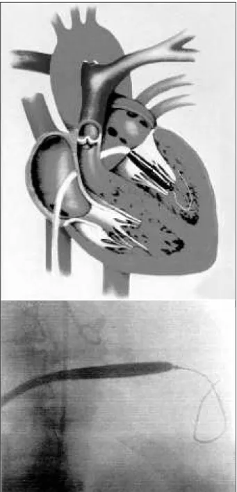 Fig. 3 - Dilation of the atrial septum puncture site with an 18 F dilator.