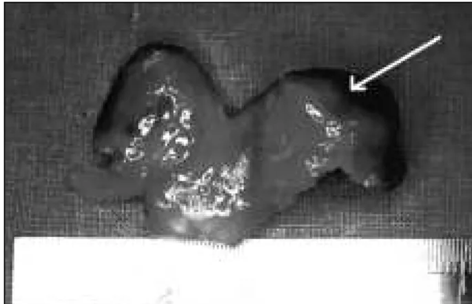Fig. 2 – Tumor in the right ventricle extending to the outflow tract.