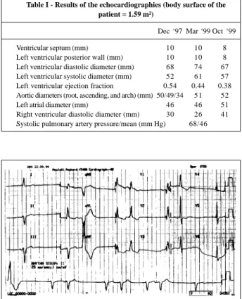 Fig.  3 - Electrocardiogram (9/22/99). Atrioventricular dissociation with junctional escape and captures simulating atrial bigeminy.