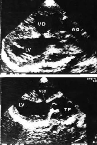 Fig. 1 – Four-chamber view. A) Observe the severe dilation of the right chambers in case 1, which was associated with the total form of anomalous pulmonary venous connection; B) Observe the subtle predominance of the right atrium in this echocardiographic 