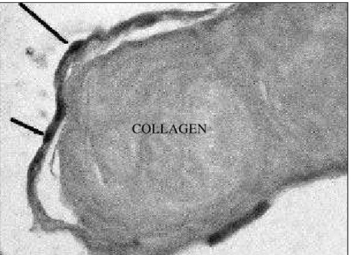 Fig. 4 – Microscopy of the tumor mass showing connective tissue lined by a single layer of flat endothelial cells.
